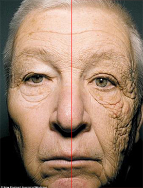 UVA에 의한 노화 비교 이미지